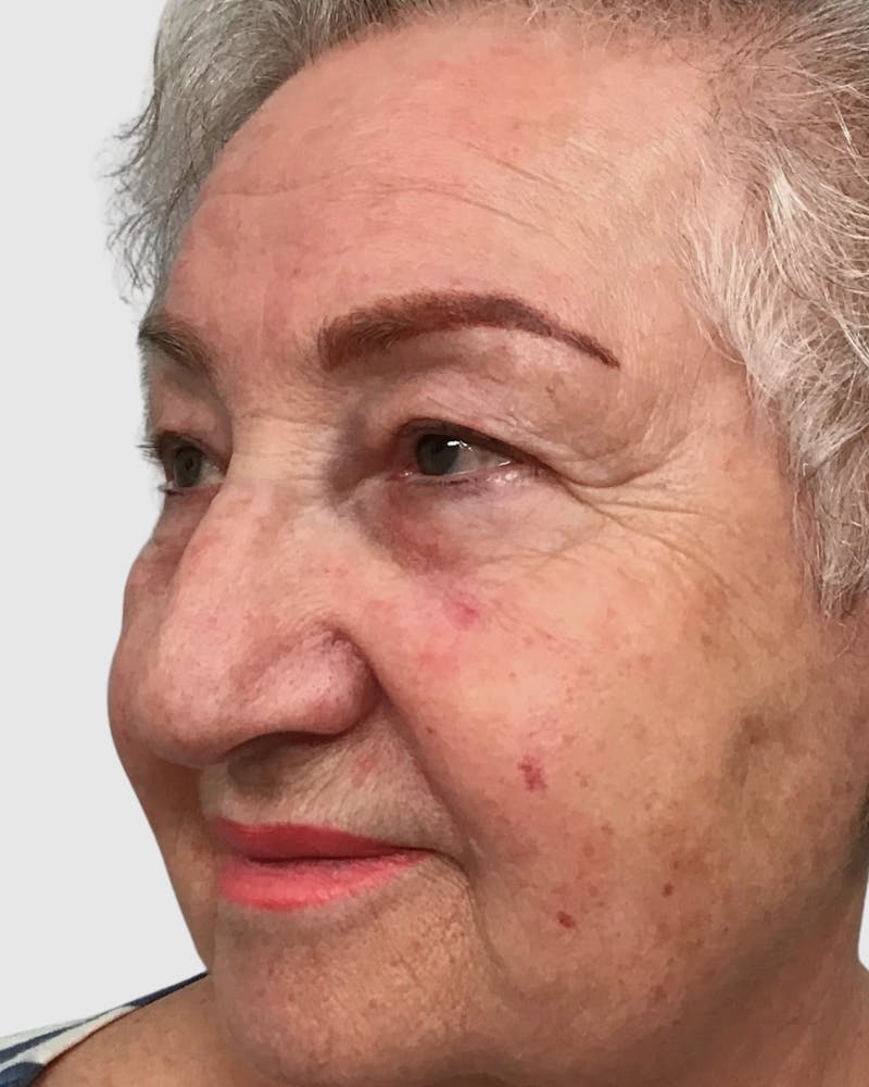 Blepharoplasty Before & After Gallery - Patient 272583 - Image 3
