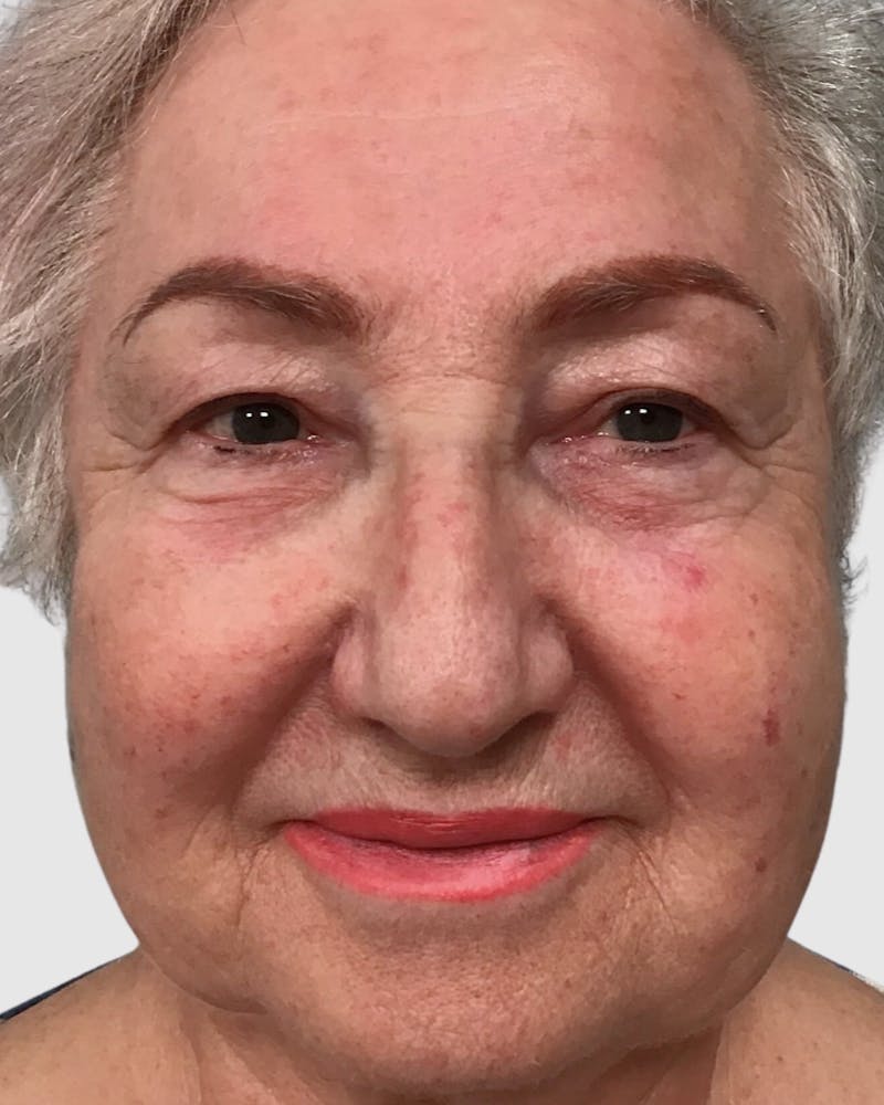 Blepharoplasty Before & After Gallery - Patient 272583 - Image 1