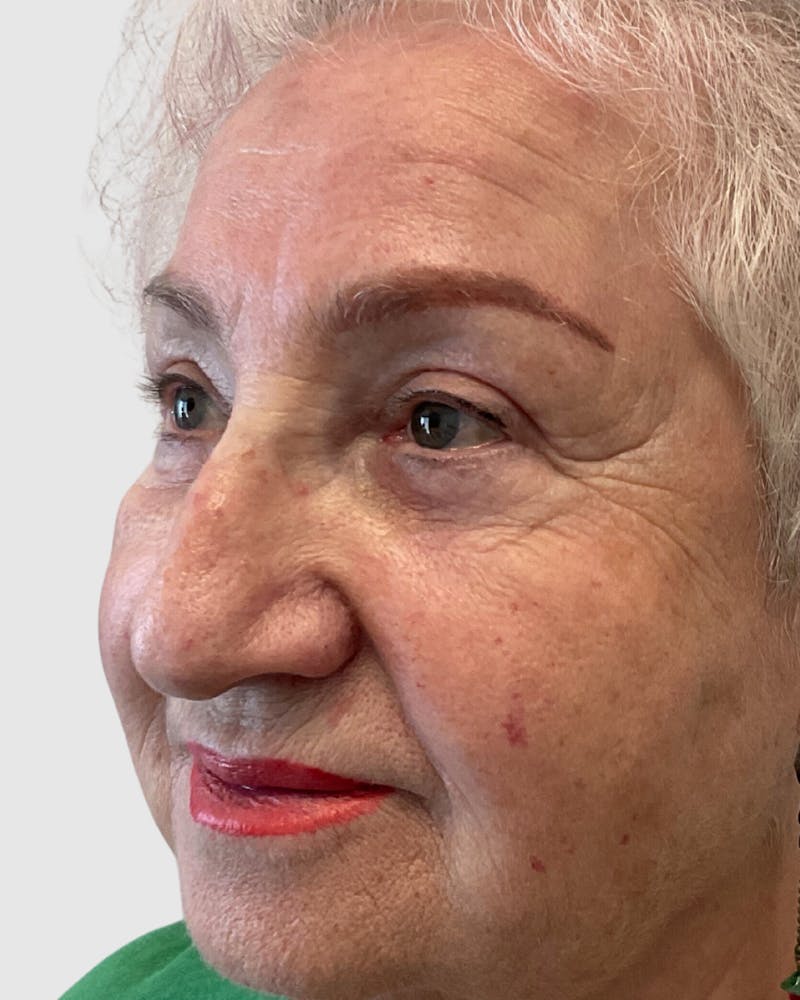 Blepharoplasty Before & After Gallery - Patient 272583 - Image 4