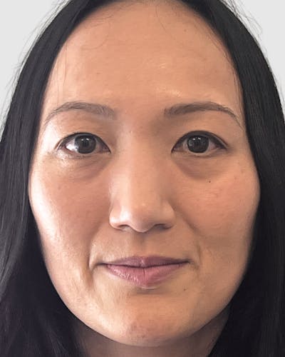Blepharoplasty Before & After Gallery - Patient 323208 - Image 1