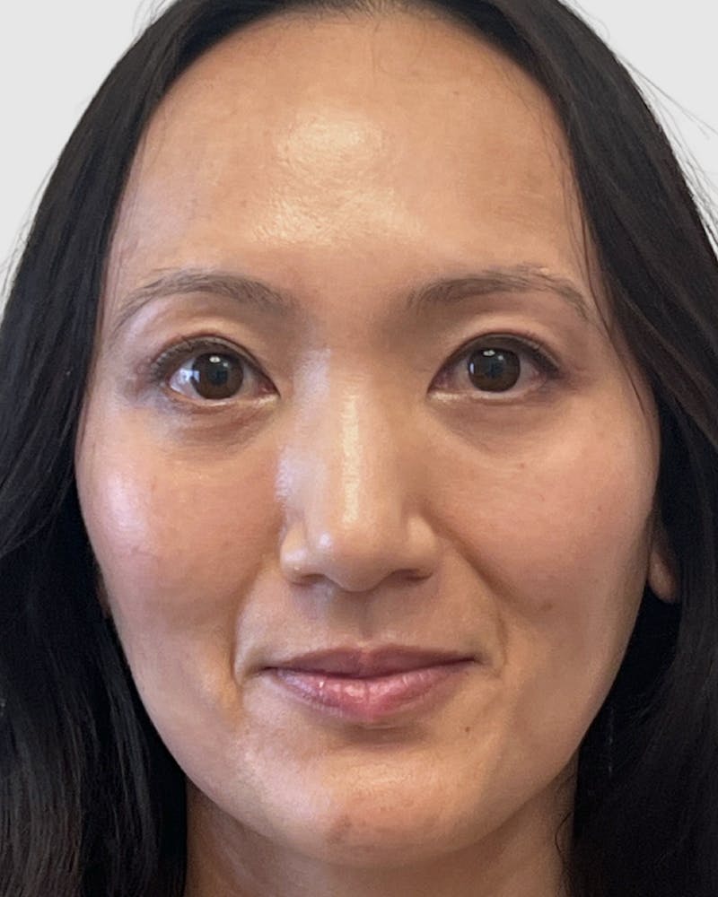 Blepharoplasty Before & After Gallery - Patient 323208 - Image 2