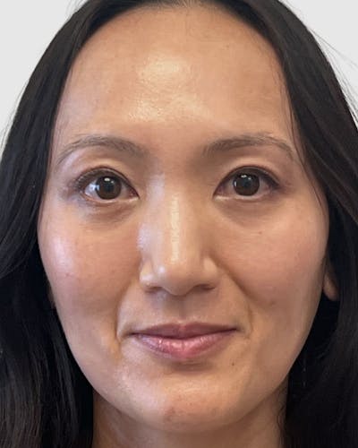 Blepharoplasty Before & After Gallery - Patient 323208 - Image 2