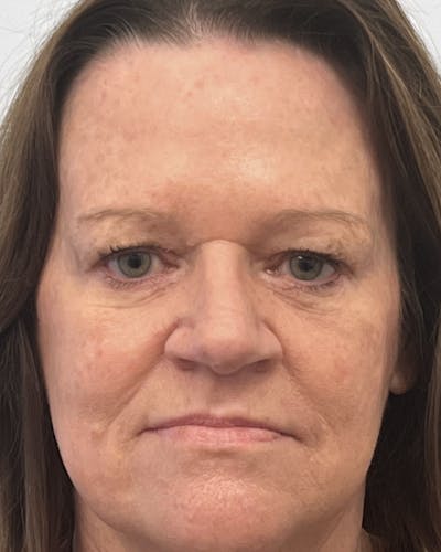 Blepharoplasty Before & After Gallery - Patient 362840 - Image 1