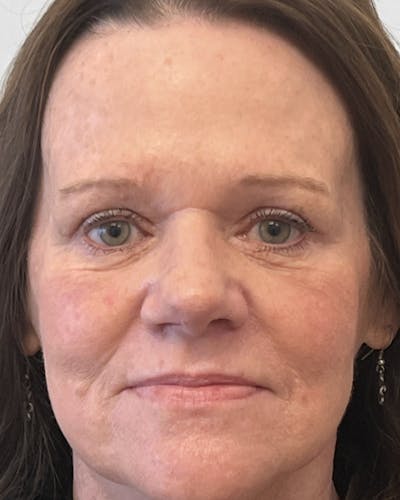 Blepharoplasty Before & After Gallery - Patient 362840 - Image 2