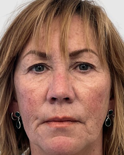 Blepharoplasty Before & After Gallery - Patient 183557 - Image 1