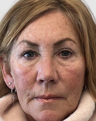 Blepharoplasty Before & After Gallery - Patient 183557 - Image 2