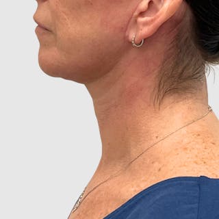 Face and Neck Lifts Before & After Gallery - Patient 424326 - Image 4