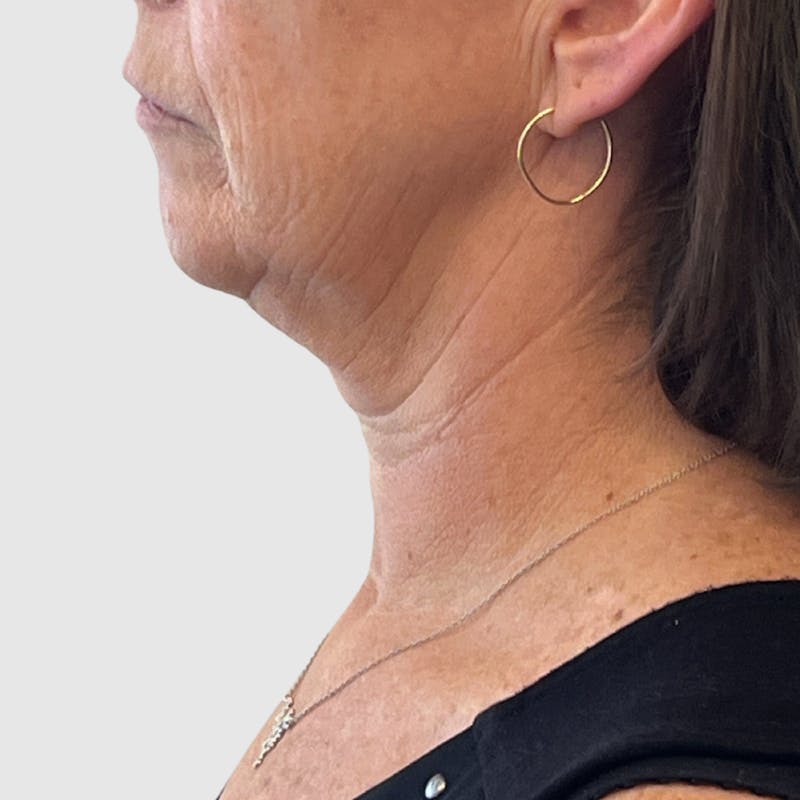 Face and Neck Lifts Before & After Gallery - Patient 424326 - Image 3