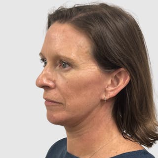 Face and Neck Lifts Before & After Gallery - Patient 424326 - Image 6