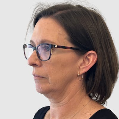 Face and Neck Lifts Before & After Gallery - Patient 424326 - Image 1