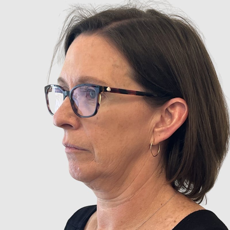 Face and Neck Lifts Before & After Gallery - Patient 424326 - Image 5