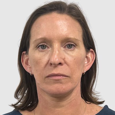 Face and Neck Lifts Before & After Gallery - Patient 424326 - Image 2