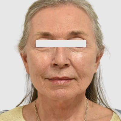 Face and Neck Lifts Before & After Gallery - Patient 253284 - Image 2