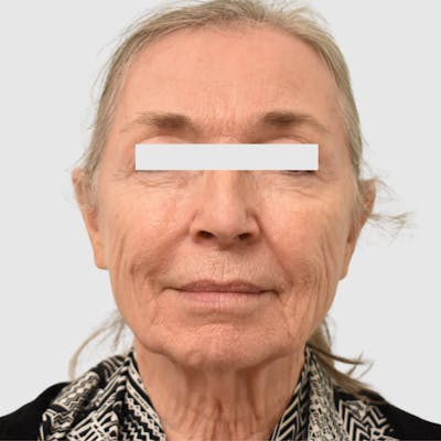 Face and Neck Lifts Before & After Gallery - Patient 253284 - Image 1