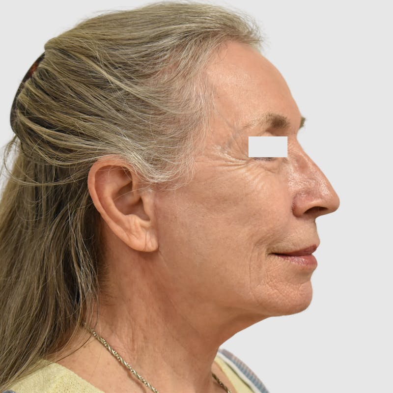 Face and Neck Lifts Before & After Gallery - Patient 253284 - Image 4