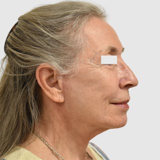 Face and Neck Lifts Before & After Gallery - Patient 253284 - Image 4