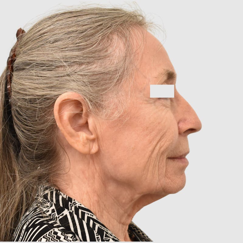 Face and Neck Lifts Before & After Gallery - Patient 253284 - Image 3