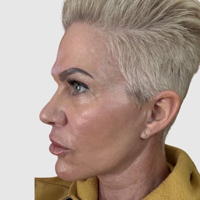 Face and Neck Lifts Before & After Gallery - Patient 427695 - Image 2