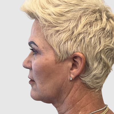 Face and Neck Lifts Before & After Gallery - Patient 427695 - Image 1