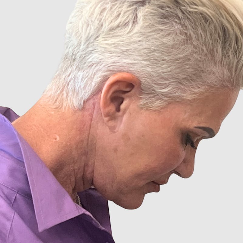 Face and Neck Lifts Before & After Gallery - Patient 427695 - Image 3