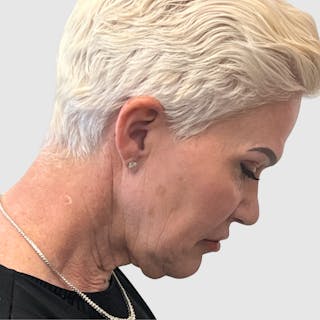 Face and Neck Lifts Before & After Gallery - Patient 427695 - Image 4