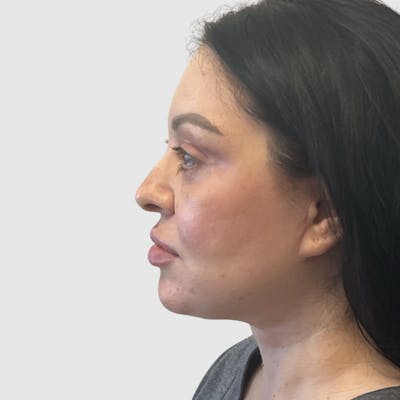 Face and Neck Lifts Before & After Gallery - Patient 219934 - Image 2