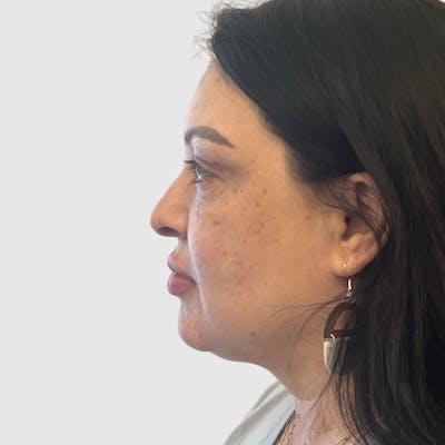 Face and Neck Lifts Before & After Gallery - Patient 219934 - Image 1