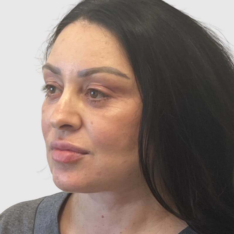 Face and Neck Lifts Before & After Gallery - Patient 219934 - Image 6