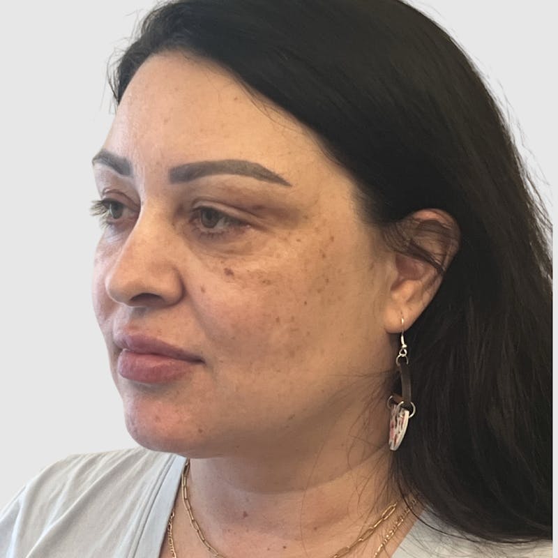 Face and Neck Lifts Before & After Gallery - Patient 219934 - Image 5