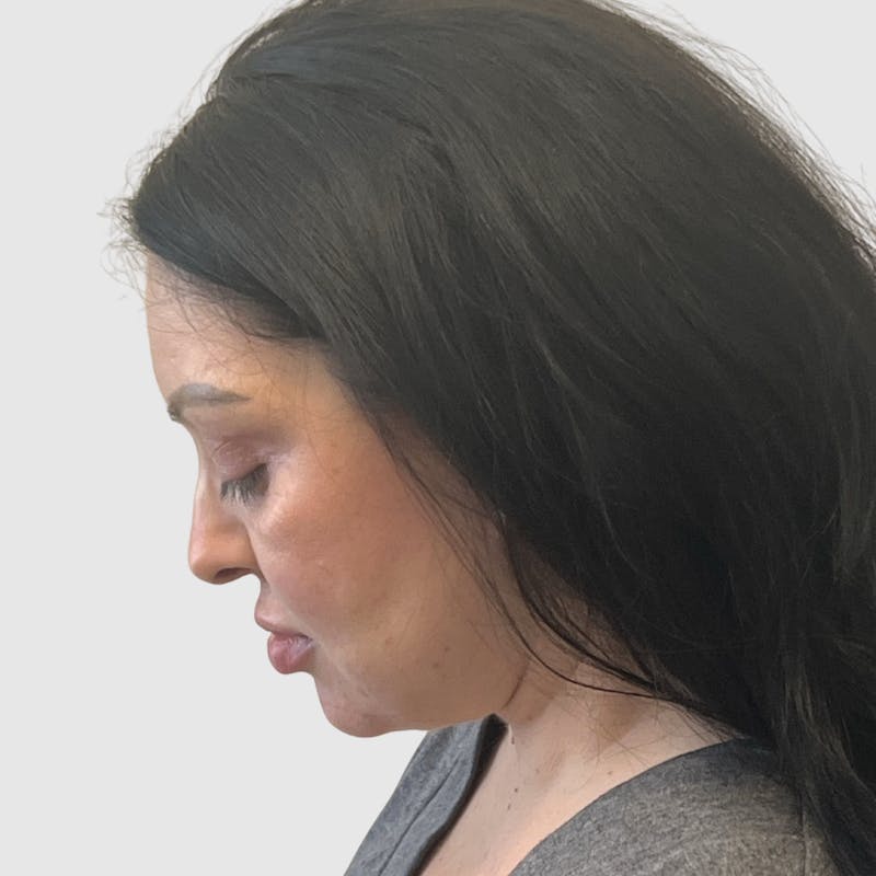Face and Neck Lifts Before & After Gallery - Patient 219934 - Image 4