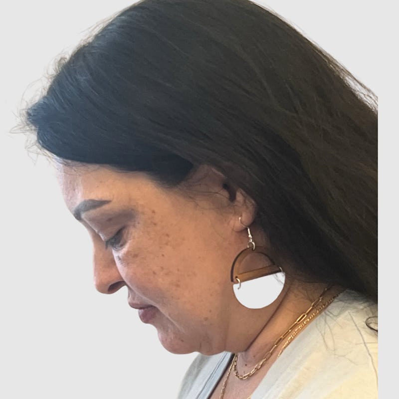 Face and Neck Lifts Before & After Gallery - Patient 219934 - Image 3