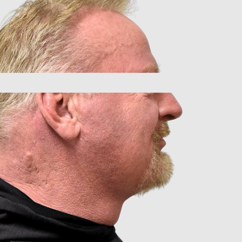 Face and Neck Lifts Before & After Gallery - Patient 157283 - Image 4