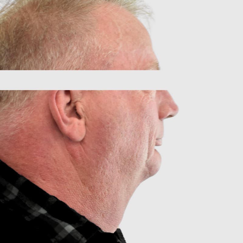 Face and Neck Lifts Before & After Gallery - Patient 157283 - Image 3