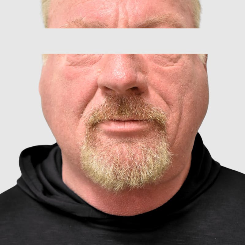 Face and Neck Lifts Before & After Gallery - Patient 157283 - Image 2