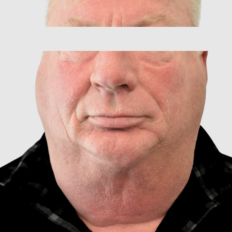 Face and Neck Lifts Before & After Gallery - Patient 157283 - Image 1
