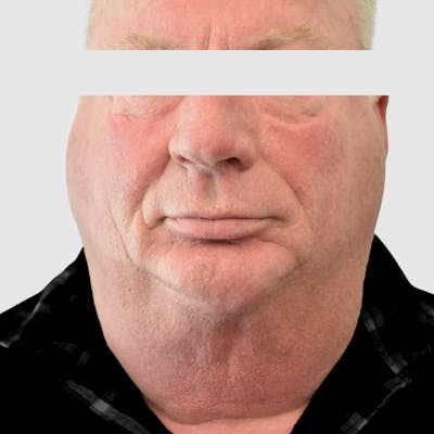 Face and Neck Lifts Before & After Gallery - Patient 157283 - Image 1