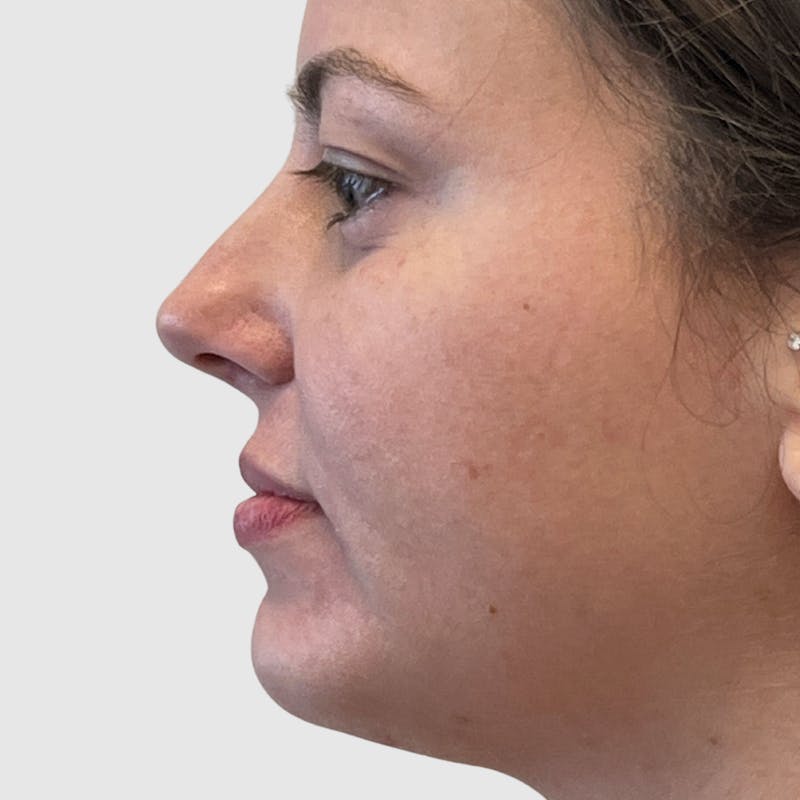Chin Augmentation Before & After Gallery - Patient 388854 - Image 4