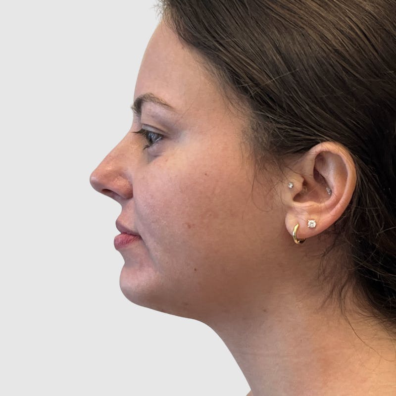 Chin Augmentation Before & After Gallery - Patient 388854 - Image 2