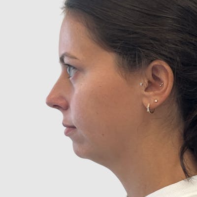 Chin Augmentation Before & After Gallery - Patient 388854 - Image 1