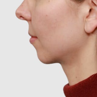 Neck Liposuction Before & After Gallery - Patient 241975 - Image 2