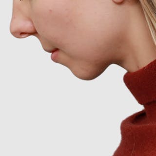 Neck Liposuction Before & After Gallery - Patient 241975 - Image 4