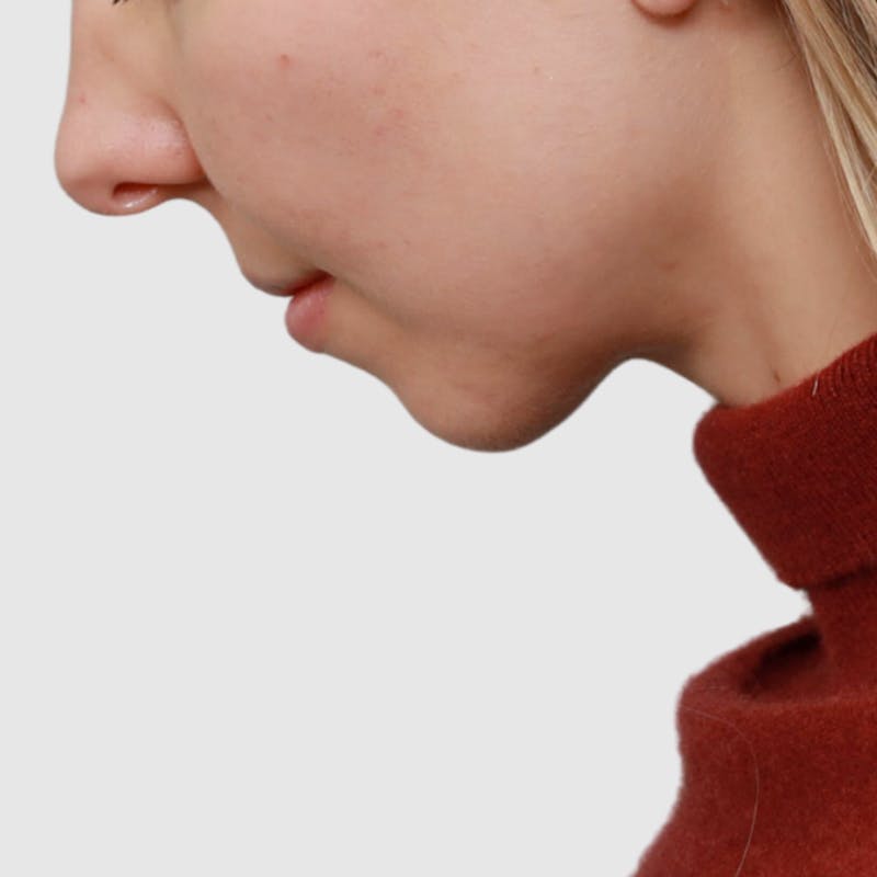 Neck Liposuction Before & After Gallery - Patient 241975 - Image 4