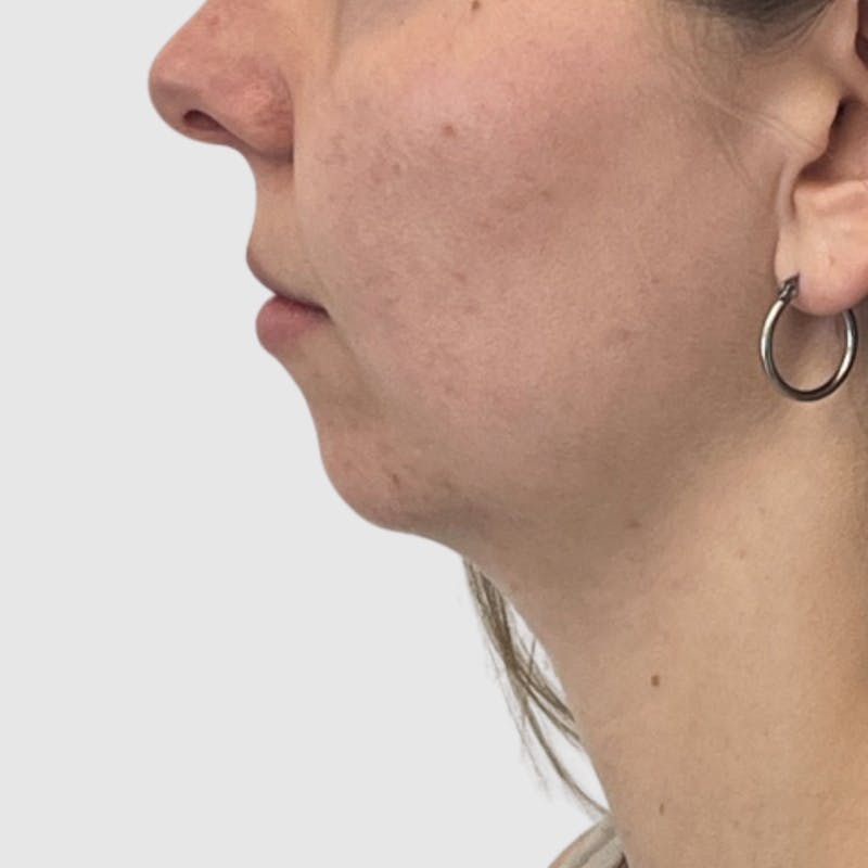 Neck Liposuction Before & After Gallery - Patient 241975 - Image 1