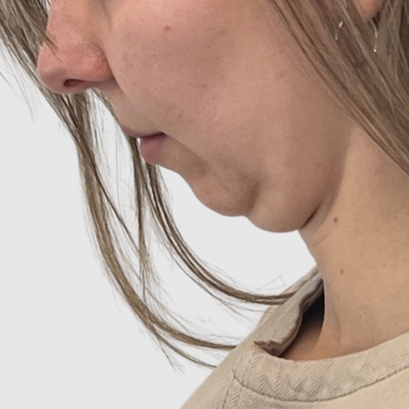 Neck Liposuction Before & After Gallery - Patient 241975 - Image 3