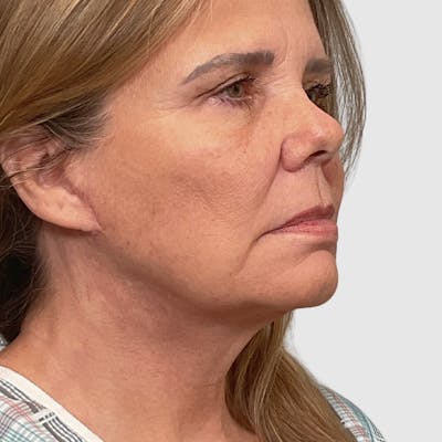 Face and Neck Lifts Before & After Gallery - Patient 130552 - Image 2