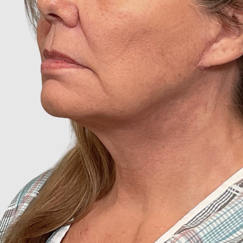 Face and Neck Lifts Before & After Gallery - Patient 130552 - Image 4
