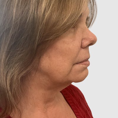 Face and Neck Lifts Before & After Gallery - Patient 130552 - Image 1