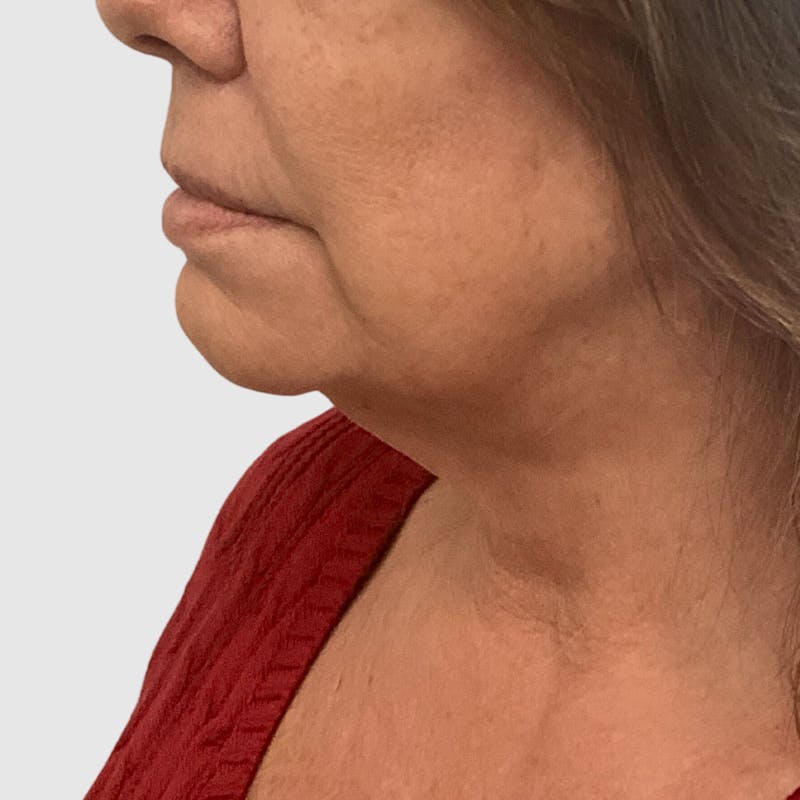 Face and Neck Lifts Before & After Gallery - Patient 130552 - Image 3