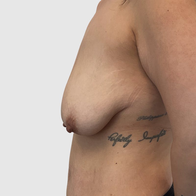 Fat Transfer Breast Augmentation Before & After Gallery - Patient 338945 - Image 3