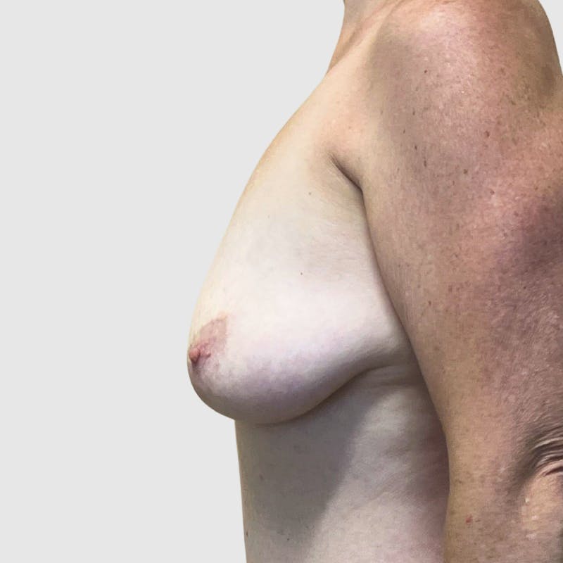 Fat Transfer Breast Augmentation Before & After Gallery - Patient 245351 - Image 3